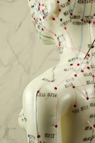 Female,Acupuncture,Model,With,Needles,In,The,Shoulder