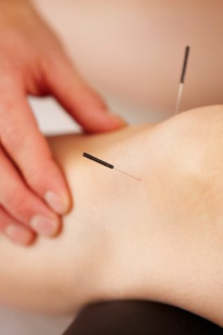 View of woman's leg with acupuncture needles